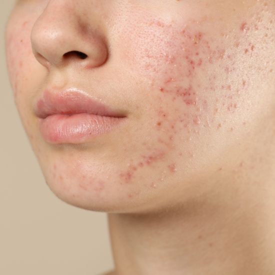 Acne Skin Care