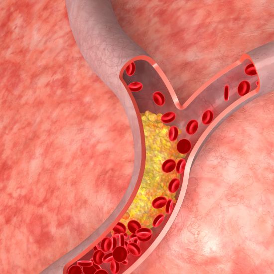 Cholesterol Management
